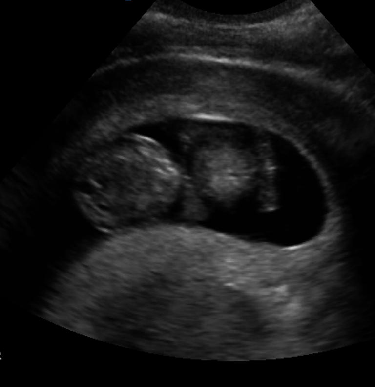 ultrasounds at 13 weeks. There are arms and legs and a